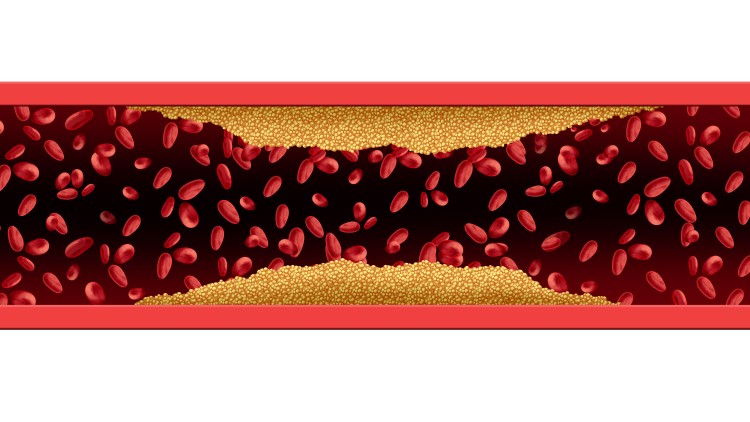 Illustration of artery and cholesterol risk