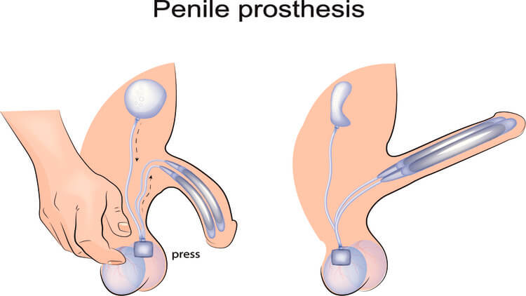 an infographic about penile prosthesis