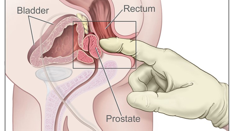 Rectal exam digital diagram